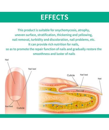 Nail Fungus Removal Liquid - Natural Toenail Fungus Oil for Effective Nail Care | BTSEURY - Buy Online on GoSupps.com
