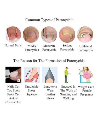 Ingrown Toenail Corrector Strips - 10pcs Bottle, Straightener Clip for Thick Toenails - Foot Tool for Correction - Buy Online on GoSupps.com
