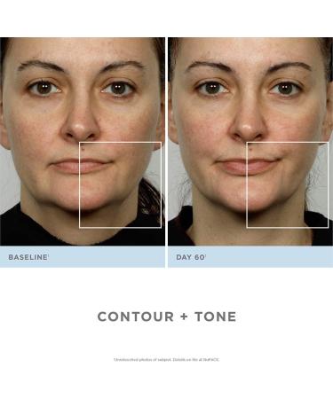 Nuface Trinity Starter Kit - Ultimate Facial Toning Device for Radiant Skin | Fast International Shipping - Buy Online on GoSupps.com