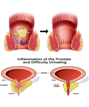Heca Natural Herbal Hemorrhoid Capsules - Rapid Relief Suppository for Quick Discomfort Treatment - 3pcs - Buy Online on GoSupps.com
