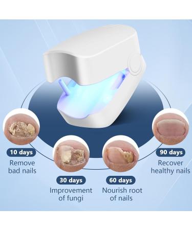 Toenail Fungus Cleaning Device - Heal Discolored & Thick Nails Fast | International Shipping - Buy Online on GoSupps.com