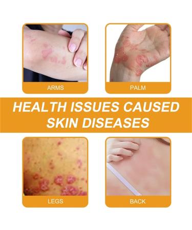 Todahof Bee Venom Psoriasis Treatment Cream Bee Venom Psoriasis Treatment Cream Todahof Bee Venom Relief Cream Todahof Bee Venom Ointment Psoriasis Cream 30 g (2 Pieces) 2 pieces. - Buy Online on GoSupps.com