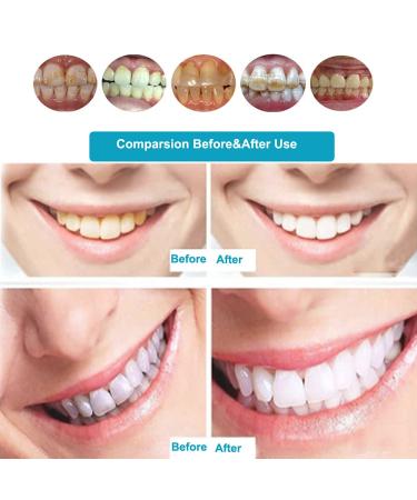 Remote Control Mobile Teeth Whitening Lamp 36W 10 LED Dental LED Teeth Whitening Accelerator 3 Colors Blue/Purple/Red Light Teeth Whitener Bleaching System with Mouth Opener/Goggles/Bibs 110V Type 1-3 Color - Buy Online on GoSupps.com