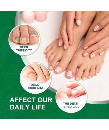 Soins des Ongles pour Les Ongles - Solution d'pied r paration d'ongle - Forte r paration et Soin des Ongles m dicament pour Les Pieds et Les Orteils s r et Efficace (10 - Buy Online on GoSupps.com