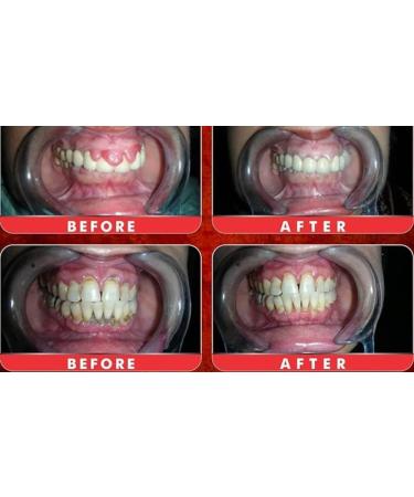 Natural Gum Care Powder - Effective Treatment for Gingivitis Bleeding Gums & Bad Breath - Organic Vegan 75g - Buy Online on GoSupps.com