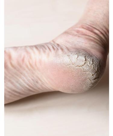 Ultimate Foot Cream & Mask - Organic Shea Butter Vitamin E Zinc - For Extreme Dryness Cracks & Baby Rash - Non-Greasy & Non-Comedogenic - 4oz - Buy Online on GoSupps.com