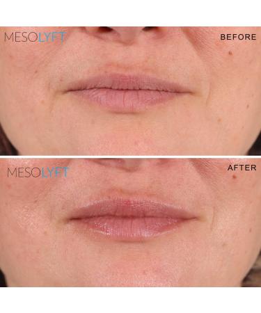 Mesolyft Neck & Lip Plumper Combo with Roller to Instantly Plump Lips & Neck - Neck Serum Improves the Neck Skin - Plumping Serum to Moisturize Your Lips and Neck - Buy Online on GoSupps.com