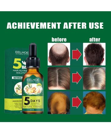 Organic Ginger Hair Regrowth Serum for Men and Women - Anti Hair Loss Treatment - Buy Online on GoSupps.com
