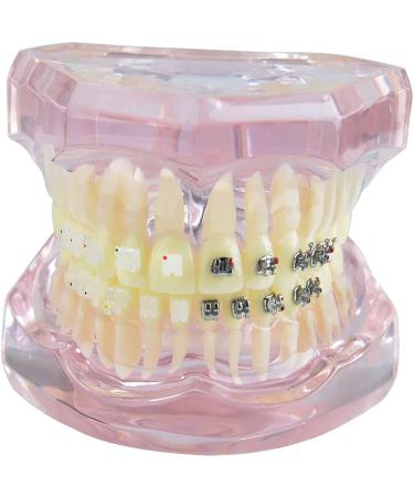 Dental Orthodontic Demonstration Model Dental Teeth Orthodontic Retainer Treatment Model with Metal Self-ligating Brackets Explaining Model