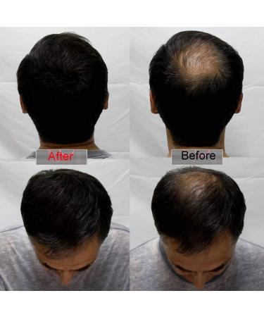 Sevich Unisex Hair Fibers - 5 Seconds to Conceal Hair Loss | Natural Keratin for Thinning Hair | 25g Black - International Shipping Available - Buy Online on GoSupps.com