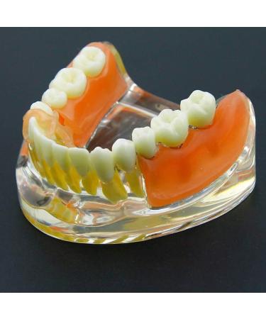 Dental Implant Restoration Model | Removable Bridge & Denture Demo for Teaching & Patient Education - Buy Online on GoSupps.com