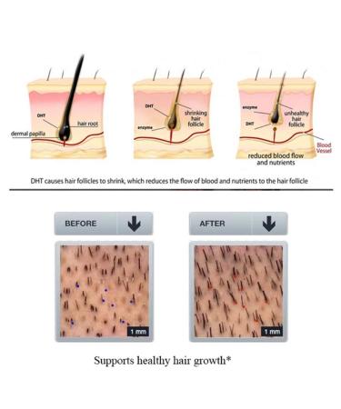 Aichun Hair Growth Essence - 100% Plant Extract Anti-Hair Loss Treatment with Ginger & Ginseng 20ml for Damaged Hair - Buy Online on GoSupps.com