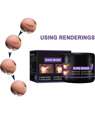 Scar Removal Cream 50ml - C-Section Skin Repair, Stretch Marks & Acne Surgery Treatment - Buy Online on GoSupps.com