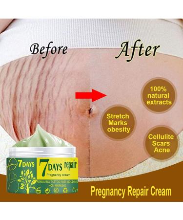 Maternity Stretch Mark Repair Cream | 7 Days to Smooth Skin | Tattoo & Scar Remover | Non-Marking Formula for Pregnancy & Postpartum | 1.67 oz (50g - Buy Online on GoSupps.com
