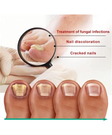 Fungus Treatment Oil Foot Fungus Oil Kerasentials Nail Treatment Healthy Natural Repair Nails Natural Toenail for Damaged & Discolored Toe Nails (2pcs) - Buy Online on GoSupps.com