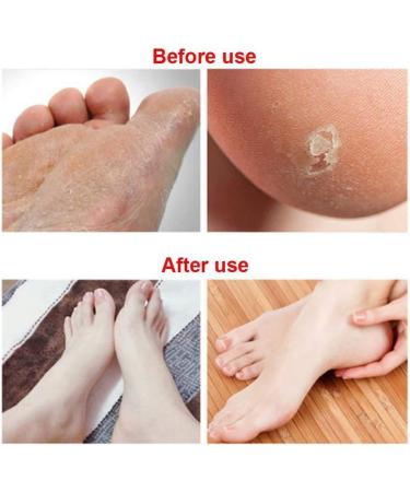 6Pcs Stainless Steel Foot File Callus Replacement Blades - Pedicure Rasp - Buy Online on GoSupps.com