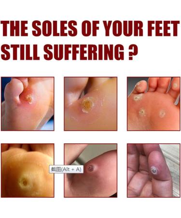SHWORON G OU Extra Strength Foot Corn Removal Gel - 1PCS - Buy Online on GoSupps.com