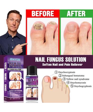 Fungal Nail Treatment Plant Essence Treatment Solution 30ML Special Nail Care Solution Athlete's Foot Toenails Broken Nails And Discolored Nails Restore Healthy Nails - Buy Online on GoSupps.com