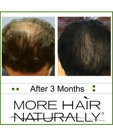 More Hair Naturally 9 - Advanced Stem Cell Therapy for Thinning Hair - Buy Online on GoSupps.com
