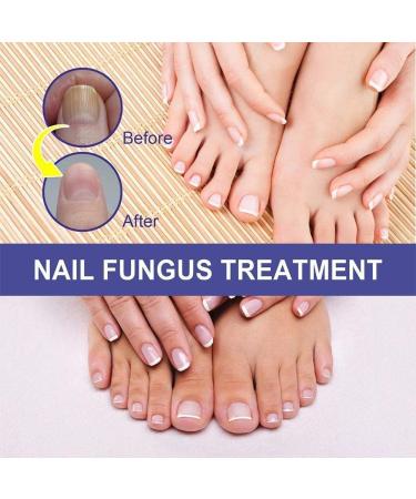 ZERZK 10ml Repair Nail Fungus Treatments Essence Foot Care Nails AntiInfection Toe Fungus Serum Onychomycosis Removal Gel - Buy Online on GoSupps.com