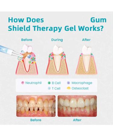 (100% 5 star) 4PCS Gum Shield Therapy Gel Dentizen Gum Therapy Gel | Gum Shield Therapy Gel and Whitening | Teeth Whitening Essence Pen | Gum Instant Treatment Gel | Gum Therapy Gel - 4ml/0.14fl.oz - Buy Online on GoSupps.com
