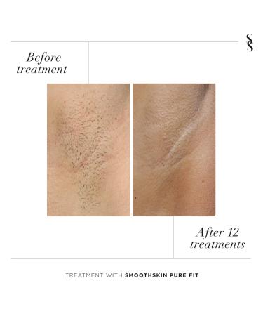 SmoothSkin Pure FIT IPL Hair Reduction Device for Women & Men - FDA Cleared - Buy Online on GoSupps.com