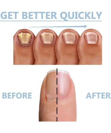 Nail Growth and Repair Serum Nail Strengthening and Growth Conditioner Nourish Strengthen And Revitalize Your Nails (1 Pcs) - Buy Online on GoSupps.com