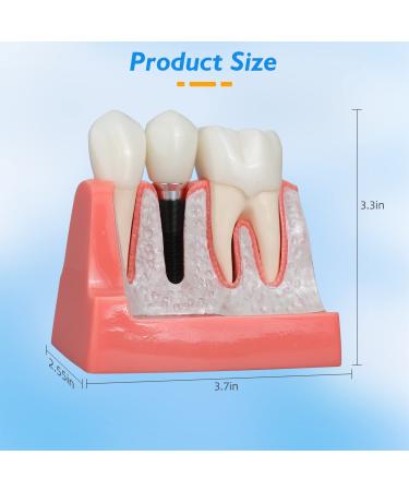 Dental Implant Model - 4 Times Removable Crown Bridge | Educational Teeth Model for Learning & Analysis - Buy Online on GoSupps.com