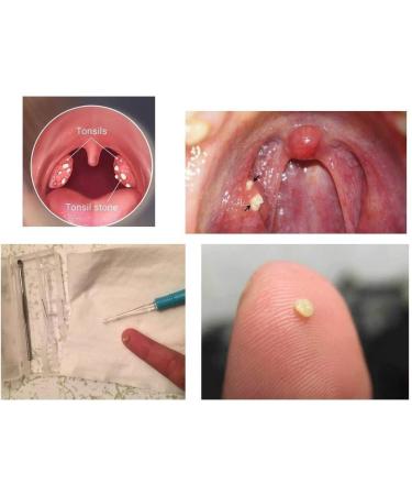 Airgoesin Upgraded Tonsil Stone Removing Tool with LED Light Pick + Mist Pump Bottle & Case - Oral Care Tool Set for Clean and Easy Use - Buy Online on GoSupps.com