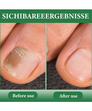 OIXYAZ OIXYA 2 pieces nail care pen nail mushroom pen nail care pen cosmetics care for nail fungal infection nail care nail fungus pens test winner with tea tree oil 8 - Buy Online on GoSupps.com