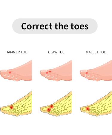 Firtink 10-Piece Hammer Toe Splint Bandage | Toe Brace & Cushion for Hammer and Broken Toes - International Shipping - Buy Online on GoSupps.com