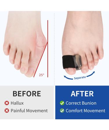 Ajoysoul Advanced Toe Separator - 6-Pack Big Toe Spacer with Elastic Band for Bunions & Overlapping Toes - Soft Gel Bunion Corrector Pad for Men & Women - Buy Online on GoSupps.com