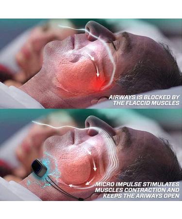 2023 Deepnite Snoreless Microdevice - Smart Snore Stopper & Nasal Congestion Respirator - Buy Online on GoSupps.com