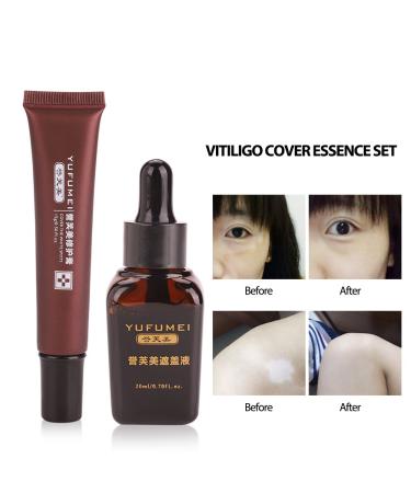 Cimenn Professional Vitiligo Cover Liquid Set - Scar & Birthmark Concealer - Buy Online on GoSupps.com