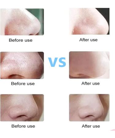 Blackhead Remover Comedone Extractor Set - Stainless Steel 2-in-1 Pimple Popper Tool for Blackhead and Pimple Removal (Silver) - Buy Online on GoSupps.com