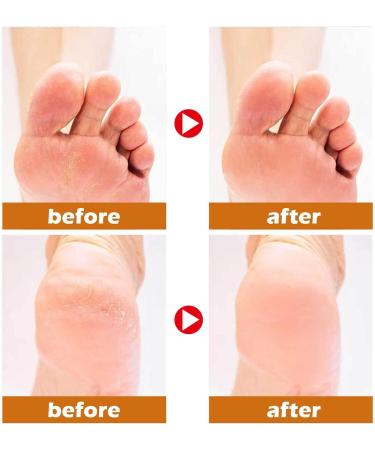 Horse Oil Foot Repair Cream 3Pcs 30g Foot Care Cream Easily Absorbed Moisturizing Horse Oil Foot Care Cream for Extremely Dry Cracked Feet - Buy Online on GoSupps.com