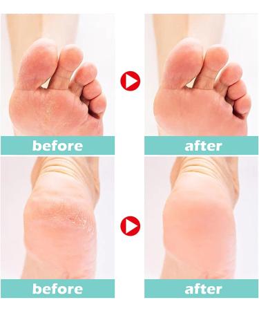 TBeautfave Urea Foot Cream 40% Urea Cream Callus Remover For Dry And Hard Skin Cracked Heel Repair Cream Deep Moisturizing Feet Cream Nourishes Soften for Feet Elbows Knees - Buy Online on GoSupps.com