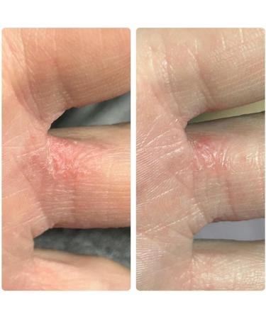 La Parea Wellness Eczema Relief Cream - Buy Online on GoSupps.com