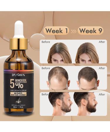 5% Minoxidil & Biotin Hair Growth Serum - 60ML for Men and Women | Hair Regrowth Treatment for Thicker, Longer, Healthier Hair | Prevent Scalp Hair Loss | Natural Formula for Fuller Hair - Buy Online on GoSupps.com