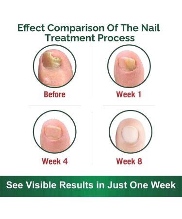 Healthy Nail Formula - Toenail Fungus Treatment & Repair Solution for Cracked, Discolored Nails - Buy Online on GoSupps.com