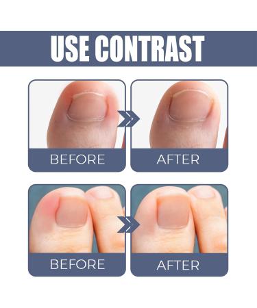 German Ingrown Toenail Drop: Paronychia Oil for Toenail Care - Nail Repair Solution (1pc) - Buy Online on GoSupps.com