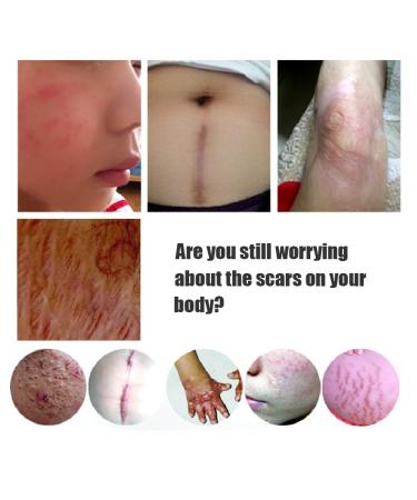 Hotiary Scar Removal Serum - Lavender Repair Essence 30g (1 Pack) - Skin Repair for Cuts, Stretch Marks, Burns & Postoperative Scars - Buy Online on GoSupps.com