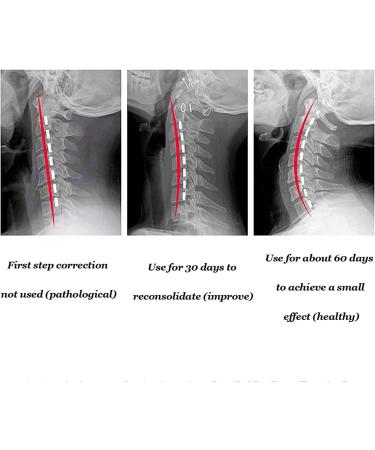 Neck Brace Collar Neck Brace Support|for Vertebrae Neck Pain Relief Chest Orthoses Posture Corrector|Relieves Neck Pain and Spine Pressure Warm as Ever - Buy Online on GoSupps.com