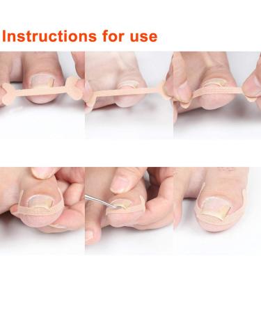 Ingrown Toenail Correction Bandage - 24 Painless Healing Tools for Paronychial Toes - Professional Care - Buy Online on GoSupps.com