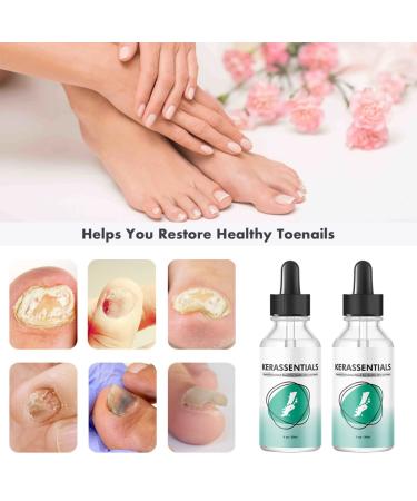 2PCS Kerassentials Toenail Treatment - Extra Strength Formula for Repairing Damaged Nails (30ml) - Buy Online on GoSupps.com