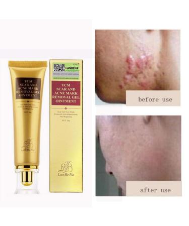 Symeas Scar & Acne Removal Cream - Effective Treatment for Stretch Marks Keloid Skin & Burns - 30g - Buy Online on GoSupps.com