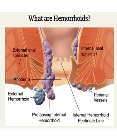 Nakyue Heca Herbal Hemorrhoid Capsules - Natural Relief for Men and Women (3 Boxes) - Buy Online on GoSupps.com