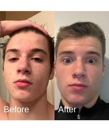 Shield Men's Acne System | Complete Face Wash Moisturizer & Pimple Patches - 4 Month Skin Care Set - Buy Online on GoSupps.com