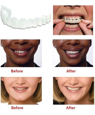 Furnier Teeth - 1 Pair of Snap-On Artificial Tooth Veneers for a Perfect Smile Instant Tooth Prostheses for Men & Women - Buy Online on GoSupps.com