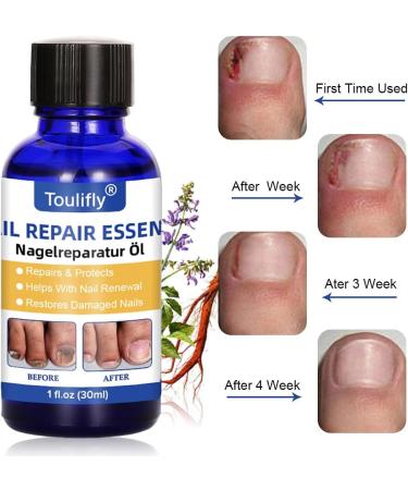 Nail Repair Natural Nail Care Maximum Strength Nail Solution Restores Discolored & Damaged Nails Nail Care Solution - Buy Online on GoSupps.com